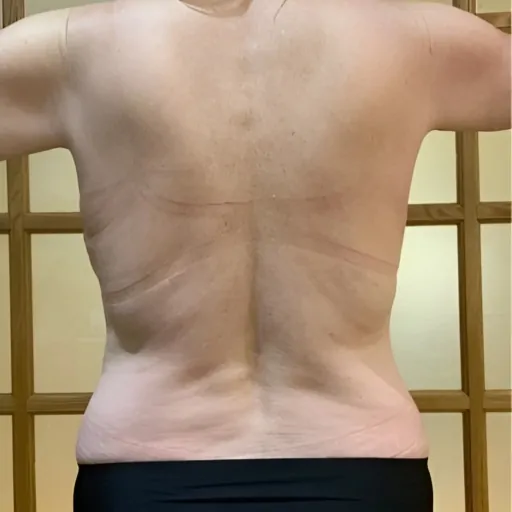 Emerald-Laser-for-Body-Contouring-Before