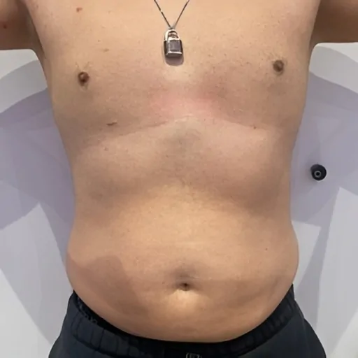 Emerald-Laser-for-Men-After