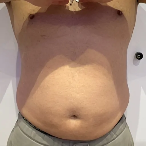 Emerald-Laser-for-Men-Before