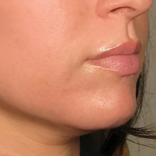 Lower Face Ultherapy After