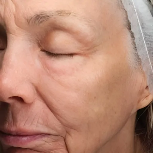 MOXI-Laser-Facial-Treatment-for-Anti-Aging-After