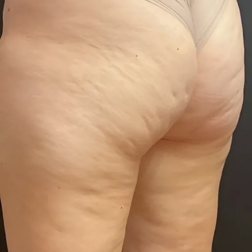MOXI-Laser-Treatment-for-Bum-Legs-Cellulite-Removal-Before
