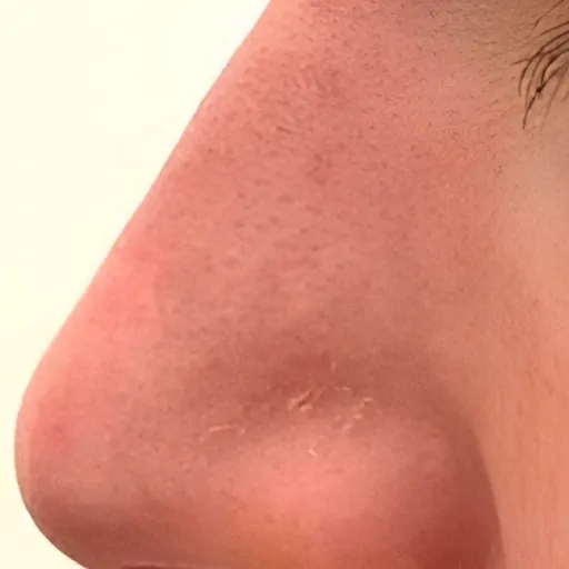 Non Surgical Nose Reshaping After