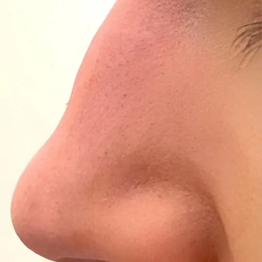 Non Surgical Nose Reshaping Before
