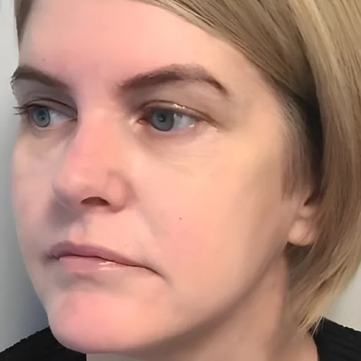 Transformational-Facelift-b2-after