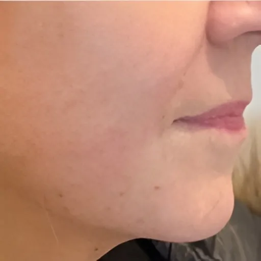 Ultracel Q Treatment After