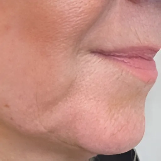 Ultracel Q Treatment Before