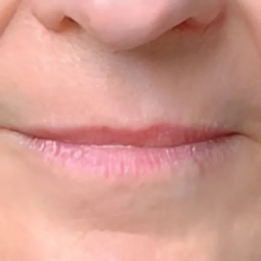 Ultracel on Lip Wrinkles After