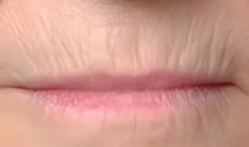 Ultracel on Lip Wrinkles Before