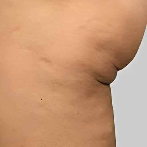 Unison Cellulite Treatment Before 1