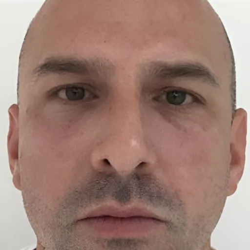 Before & After Tear trough fillers