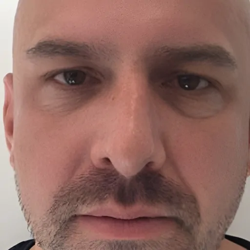 Before & After Tear trough fillers