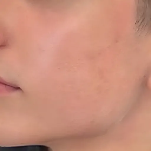moxi-laser-treatment-after