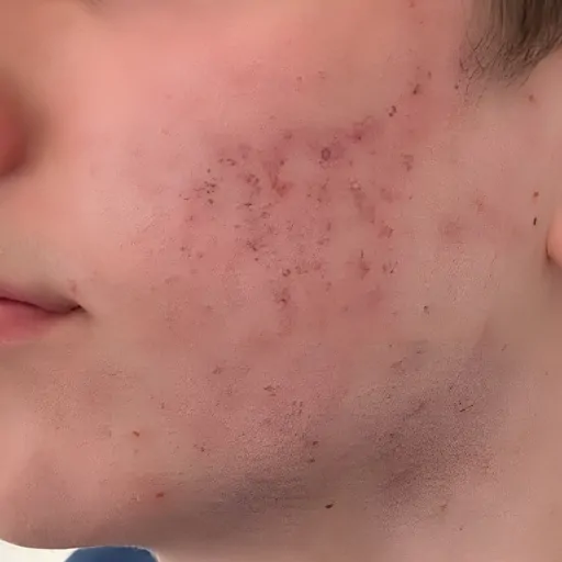 moxi-laser-treatment-before